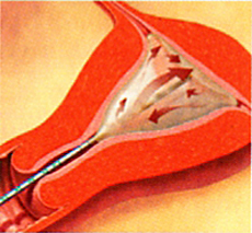 Gynecare Thermachoice | Heavy Period | Riachi Surgery | Dr. Labib Riachi