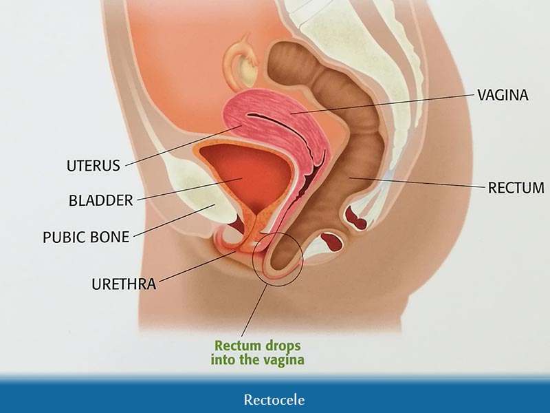 Pelvic Organ Prolapse, Pelvic Organ Prolapse, Riachi Surgery