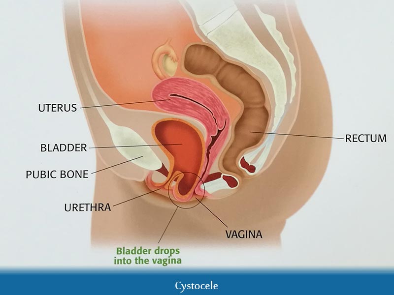 What is Pelvic Organ Prolapse?  Types of Prolapse, Diagnosis, Treatment